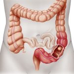 Early-onset colorectal cancer