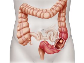 Early-onset colorectal cancer