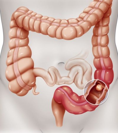 Early-onset colorectal cancer